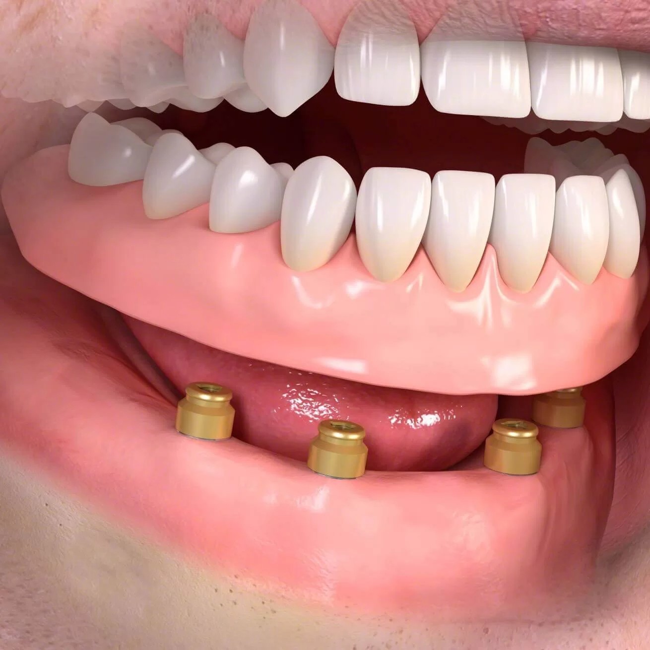 Implantátumokkal stabilizált kivehető fogsorok
