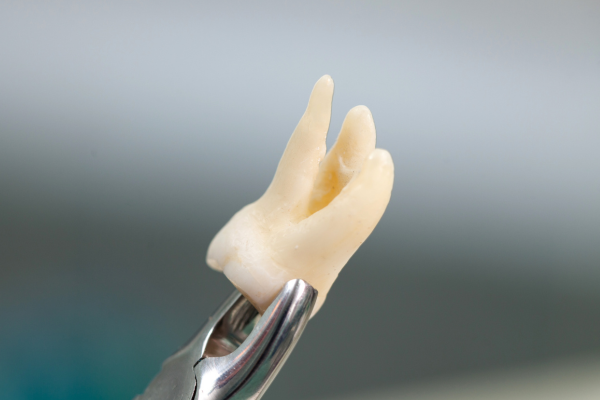 Bölcsességfog húzás és műtét – gyors kezelés fájdalom nélkül a DNP Dental fogászati rendelőben