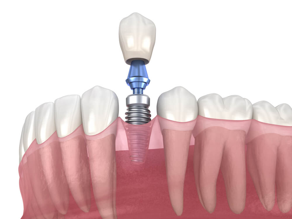 fogászati implantátum