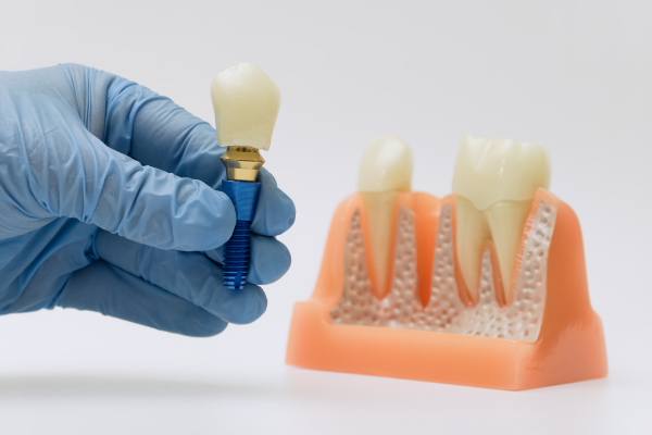 Csontpótlás nélküli implantáció