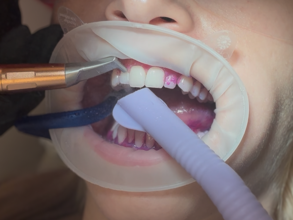 biofilm terápia dnp dental budapest 11 kerület