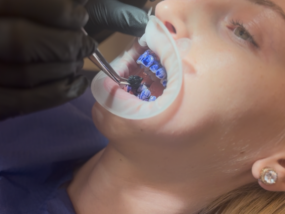 kíméletes fogkőeltávolítás 11 kerület dnp dental